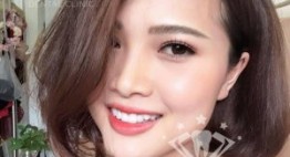 BỌC RĂNG SỨ THẨM MỸ 2IN1: Giải pháp cho hàm răng đẹp cùng nụ cười rạng rỡ