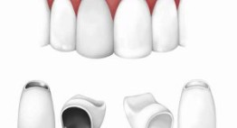 Làm răng sứ thẩm mỹ  – Phương pháp được hàng triệu người ưa chuộng