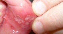 Lở miệng uống thuốc gì để nhanh khỏi – Bài thuốc chữa bệnh cực hay từ dân gian