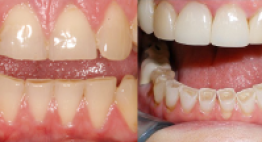 Tìm lời giải cho thắc mắc: Nguyên nhân của răng nhạy cảm là gì?