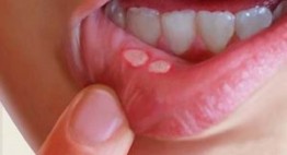 Bị lở miệng nên ăn gì để bệnh nhanh khỏi và không tái phát?