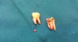 Tìm hiểu kinh nghiệm lựa chọn địa chỉ nhổ răng ở đâu tốt tại Hà Nội