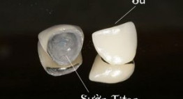 Cách làm răng sứ titan hiệu quả nhất – Tổng hợp thông tin từ A-Z