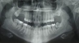 Tiêu xương răng có sao không và làm sao để khắc phục?