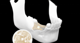 Tìm hiểu cặn kẽ vấn đề tiêu xương răng, ảnh hưởng & biện pháp