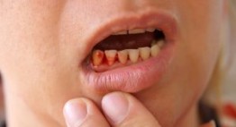 Những cảnh báo về bệnh viêm nha chu đối với sức khỏe của bạn