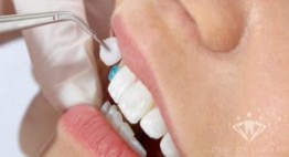 Mặt dán sứ veneer: “Chiếc áo mới” cho hàm răng xấu xí