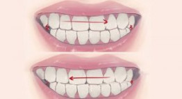 Ngủ nghiến răng là bệnh gì? Nguyên nhân nào gây ra bệnh nghiến răng?