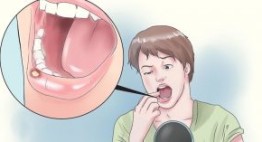 Nhiệt miệng uống thuốc gì để vết thương mau lành nhất? – Xem ngay