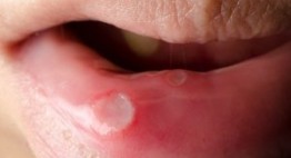 Chỉ định các loại thuốc trị nhiệt miệng TỐT nhất hiện nay