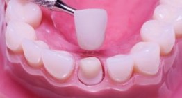 Bao nhiêu tuổi có thể bọc răng sứ? [Hỏi đáp cùng chuyên gia]