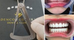 Làm răng sứ Veneer có tốt không? – Kinh nghiệm thực tế từ khách hàng