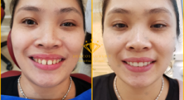 Bọc răng sứ trong bao lâu thì hoàn thành? – Thời gian được rút ngắn tối đa