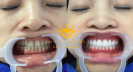 Răng bị nhiễm màu kháng sinh có làm trắng được không?