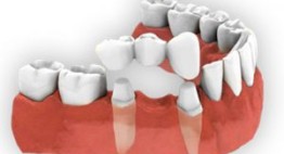 Có nên làm cầu răng sứ cho các trường hợp răng hư tổn nặng?