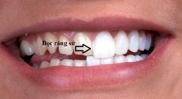 Khi nào nên bọc răng sứ? – Tư vấn các trường hợp cụ thể