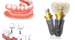 Trồng răng sứ – Đây là những kỹ thuật hiện đại không phải ai cũng biết