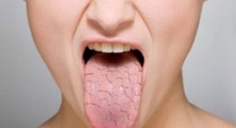 Tạm biệt tình trạng khô miệng thường xuyên xảy ra