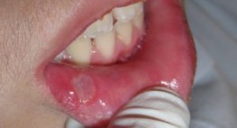 Lở miệng mãi không khỏi – Nguyên nhân và cách điều trị như thế nào?