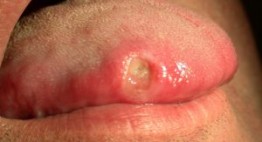 Lở miệng ở người già là gì? Nguyên nhân, triệu chứng và cách điều trị