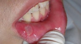 Nguyên nhân và cách trị không thể tốt hơn khi lở miệng ở trẻ 1 tuổi