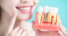 Tất tần tật những lưu ý khi trồng răng implant