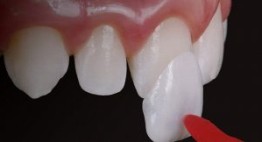 Dán sứ Veneer có nguy hiểm không?- Chuyên gia tư vấn