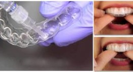 Tẩy trắng răng bằng máng giá bao nhiêu?