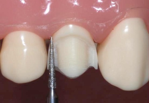 bọc răng sứ có hại gì không?