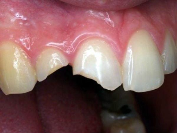 cách khắc phục răng bị mẻ