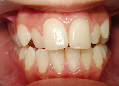 bọc răng sứ cho răng vẩu 2