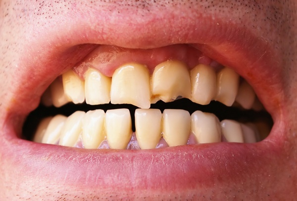 Răng sứ dùng được bao lâu?