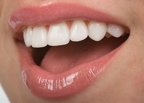 bọc răng sứ alumina 4