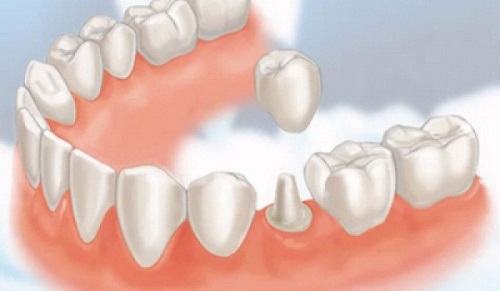 quy trình bọc răng sứ cercon 4