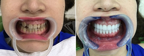 răng sứ cercon zirconia 2