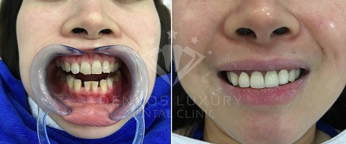 răng sứ cercon zirconia 3