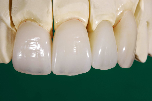 răng sứ cercon là gì 2