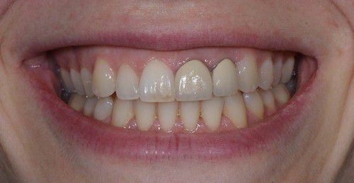 bọc răng sứ dresden 2