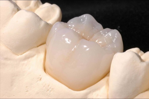 độ bền của răng sứ cercon 
