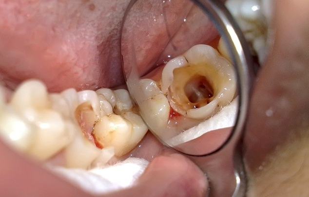 Bọc răng sứ cho răng sâu