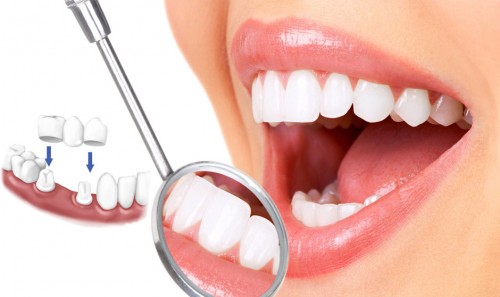 Bọc răng sứ nguyên hàm