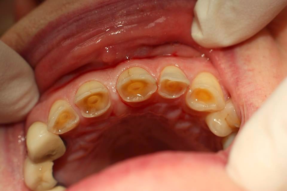 răng bị mòn mặt nhai 1