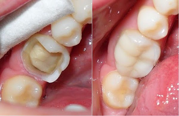 Bọc răng sứ cho răng hàm nên chọn loại nào tốt 1