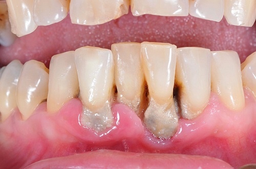 răng lung lay có bọc răng sứ được không