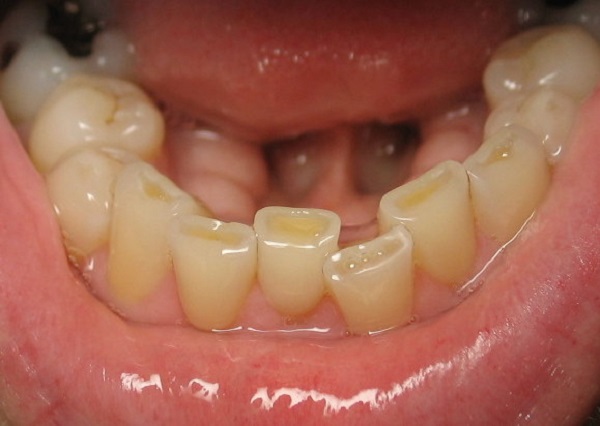 bọc răng sứ cho hàm răng bị mòn men