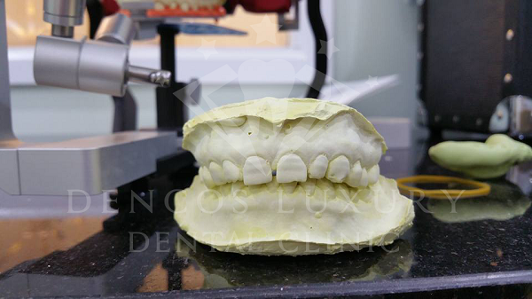 bọc răng sứ cho hàm răng bị mòn men 3