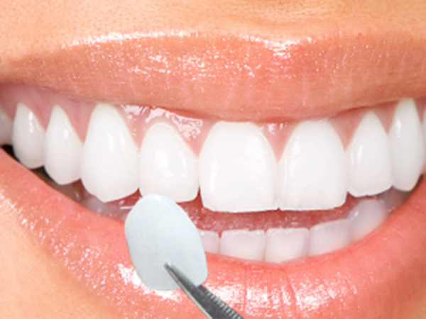 bọc răng sứ cho hàm răng bị mòn men 4
