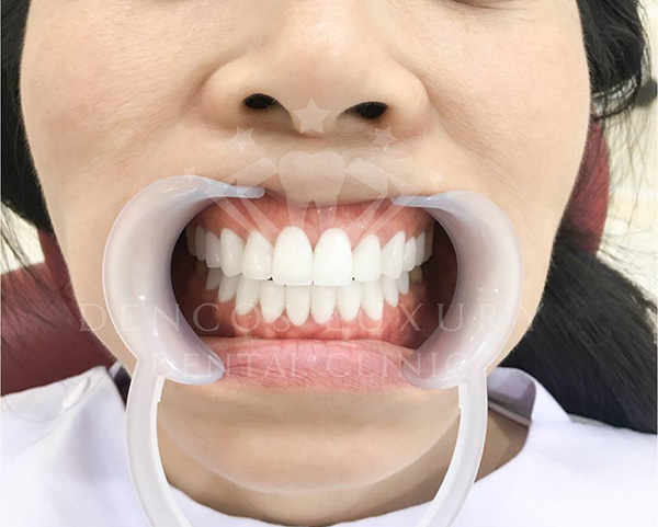 bọc răng sứ 3