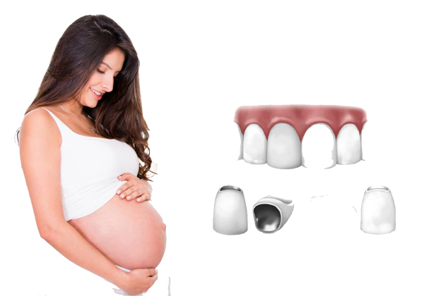 bọc răng sứ khi mang thai