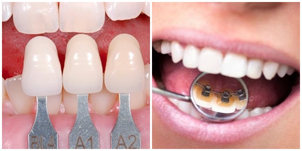 bọc răng sứ và niềng răng 